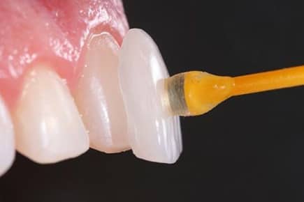 Lente Dental Poços de Caldas