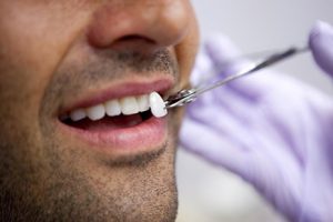 Lente dental em Poços de Caldas Lente dental em Poços de Caldas