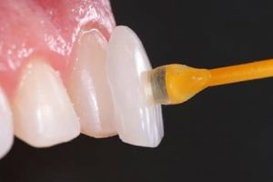 Lente Dental Poços de Caldas